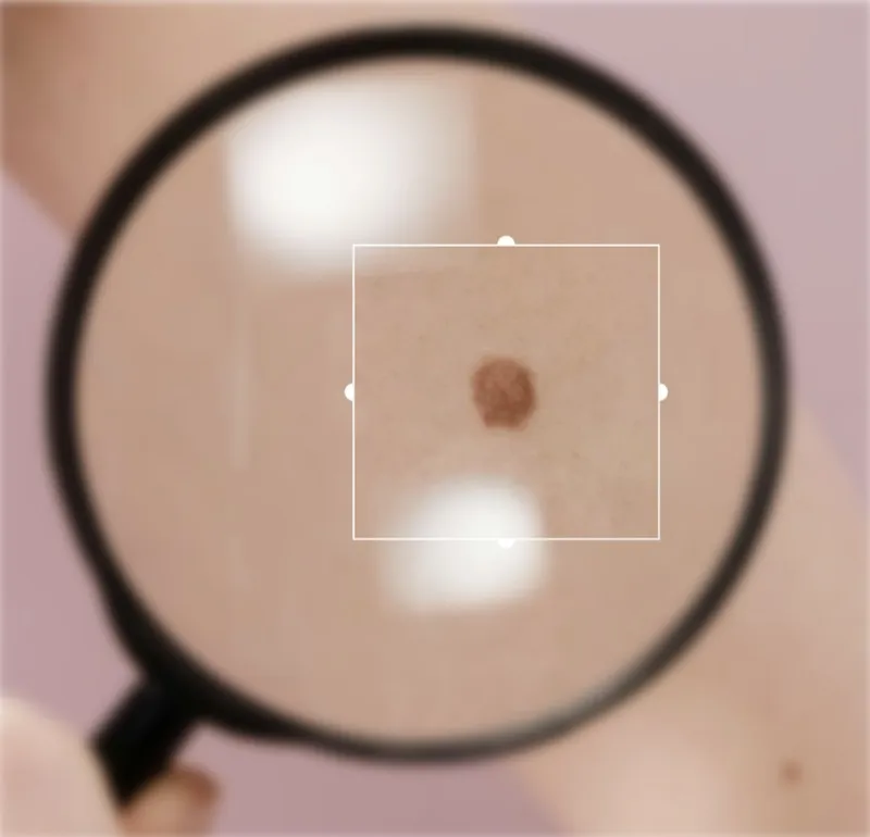 Skin Lesions