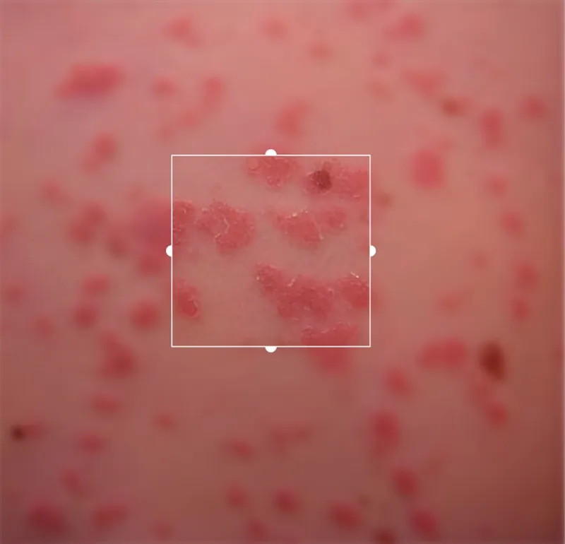 Psoriasis