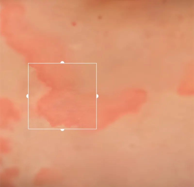 Urticaria